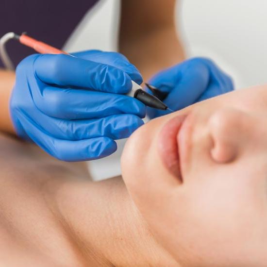 A woman getting electrolysis hair removal
